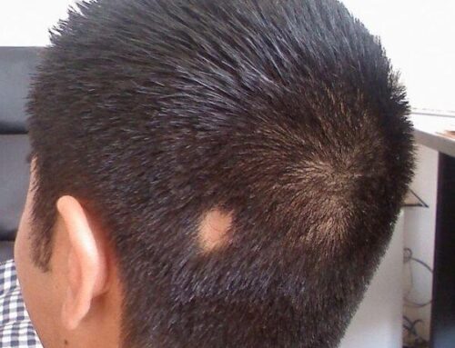 Alopecia Areata