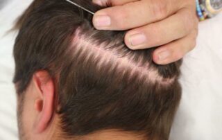 hair transplant Turkey FUT