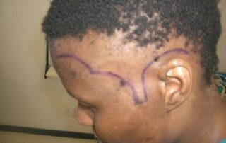 Female hair transplant