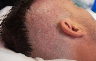 6 Steps of FUE Hair Transplant