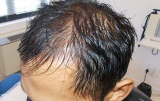 Androgenic hair loss male female