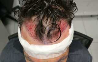 Hair Transplant Aftercare