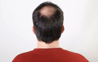 learn about hair loss myths