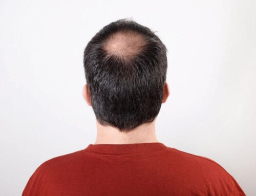 Hair Loss Myths