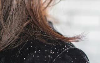 Severe dandruff