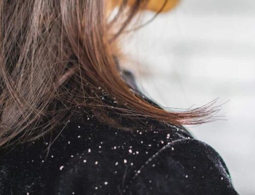 Causes and solutions to dandruff