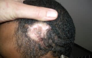 Scar repair through hair transplant surgery