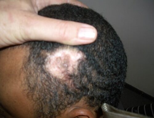 Hair transplant for scar repair