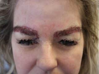 Eyebrow hair transplant