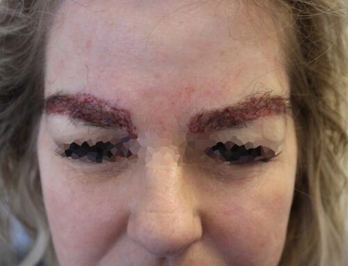 Eyebrow Hair Transplant