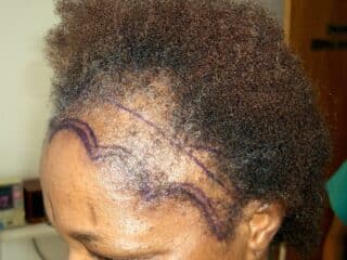 Traction alopecia hair transplant