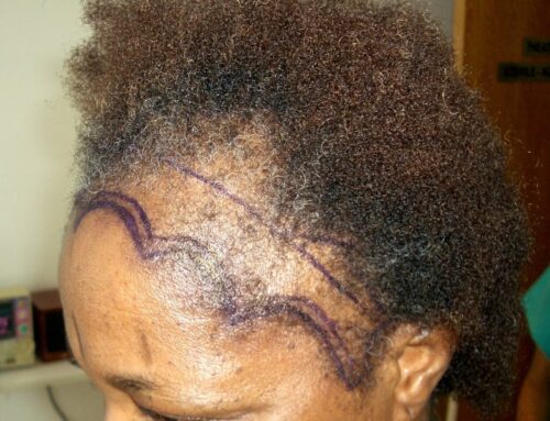Traction Alopecia Hair Transplant